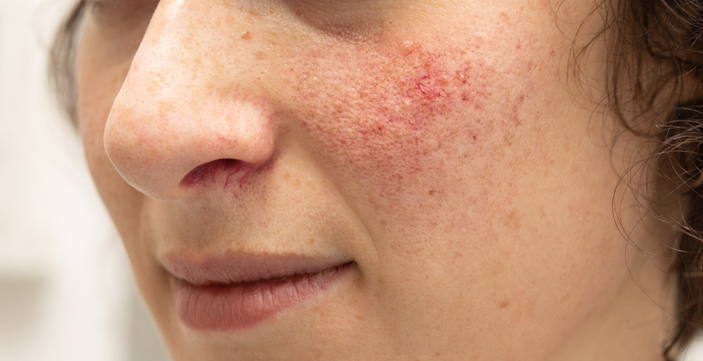 Image result for rosacea