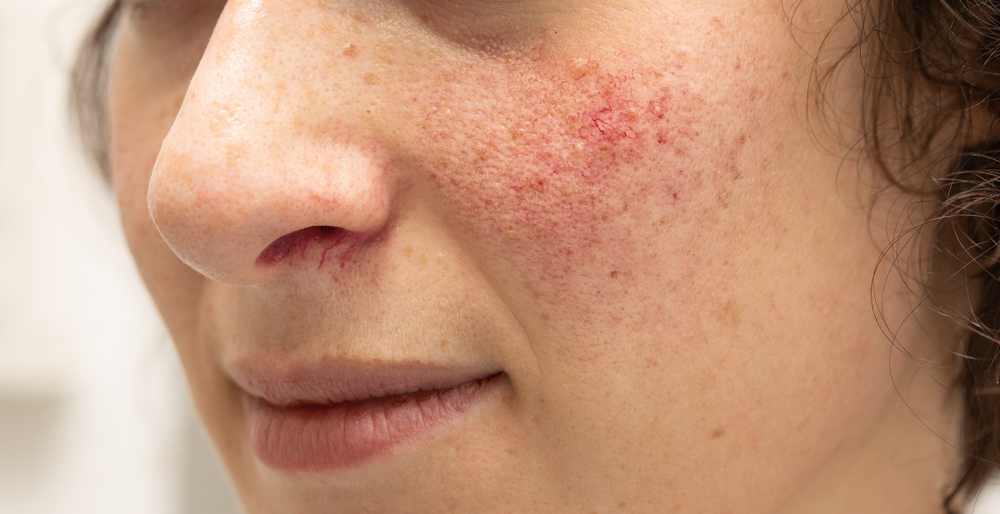 What is Rosacea?